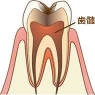 抜髄とは 根管治療４つの治療法と主な症例