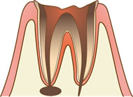 歯髄が死に、細菌が歯根の内部にまで侵入して骨の中に膿が溜まっている状態