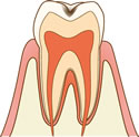 虫歯(C1)