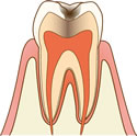 虫歯(C2)
