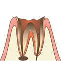虫歯(C4)