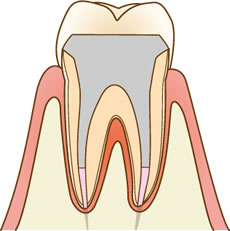 土台を入れ、人工歯を被せた歯