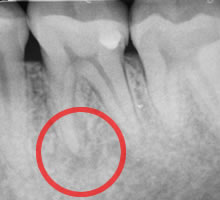 虫歯が進行したレントゲン写真