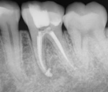 根管充填後のレントゲン