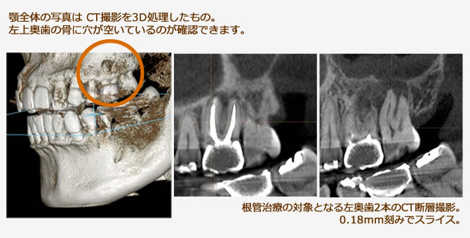 顎全体の写真は CT撮影を3D処理したもの。左上奥歯の骨に穴が空いているのが確認できます。根管治療の対象となる左奥歯2本のCT断層撮影。0.18mm刻みでスライス。