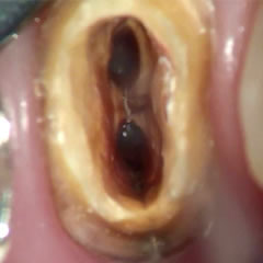 歯の内部