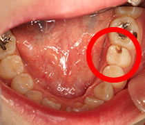 虫歯のせいで穴があいている歯