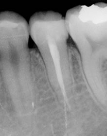 根管充填後のレントゲン