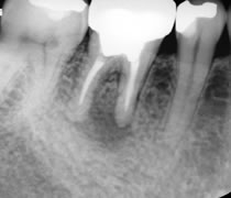 歯の根に膿がたまり骨が溶けている状態