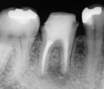 バイオセラミクセメント（MTA）で根管充填した歯