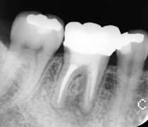 半年後の歯の経過観察