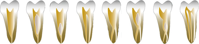 人によって異なる、さまざまな根管の形状。