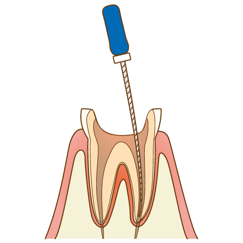 根管の汚れを除去