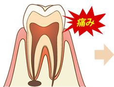 虫歯で痛みが進行している歯