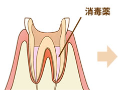 根管治療後、消毒薬で処置