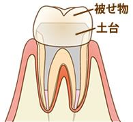土台を築きかぶせものをした歯